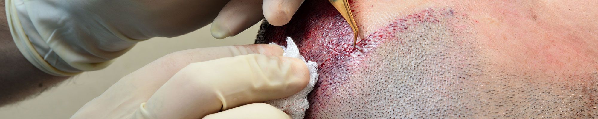 Surgical hair replacement being carried out on young man