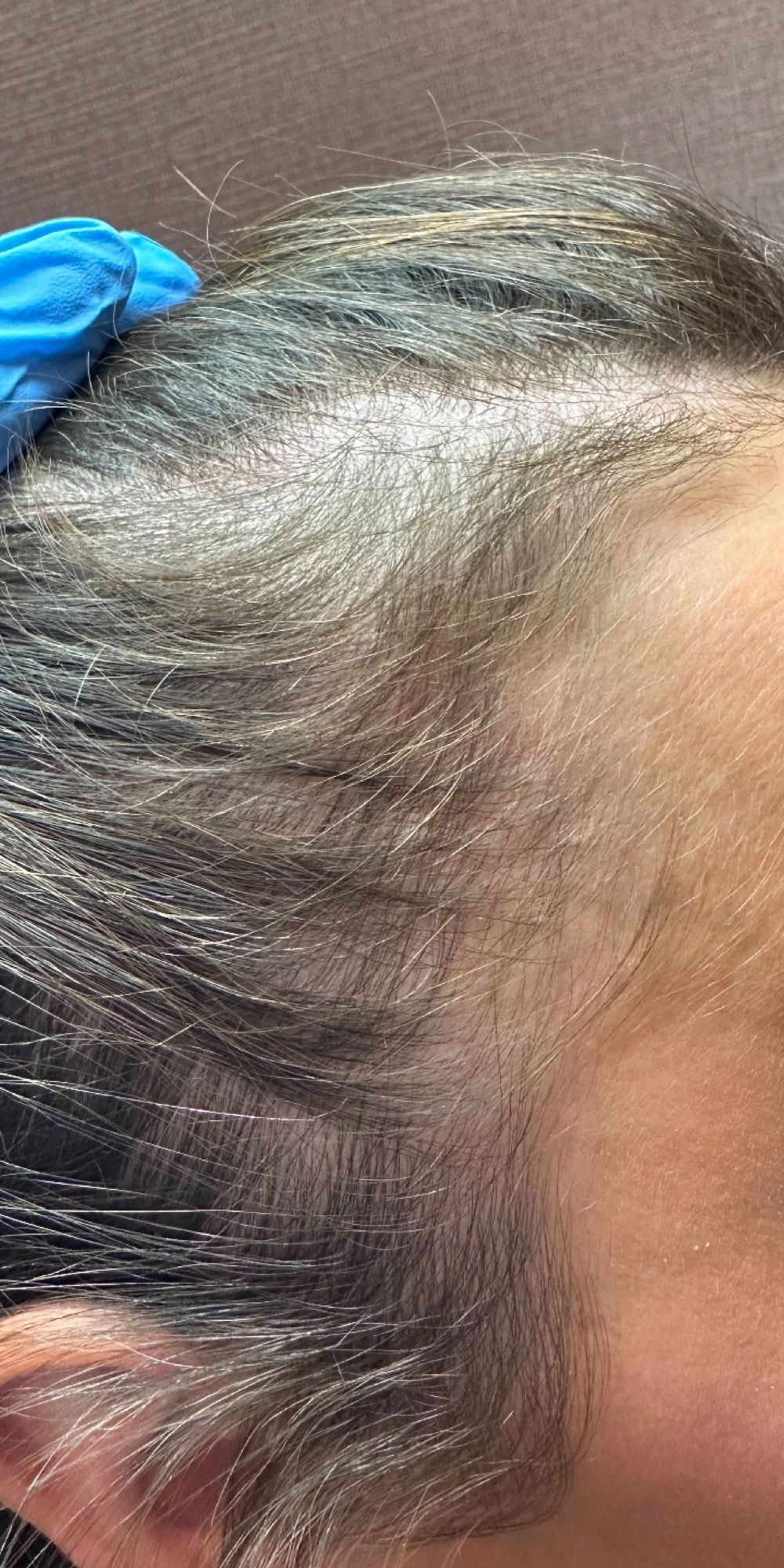 Before & after hair loss treatment