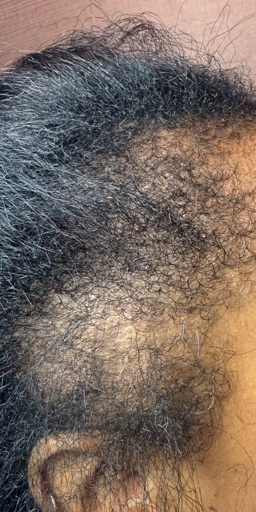 Before & after hair loss treatment