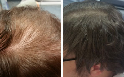 Before and after photo of male hair loss treatment