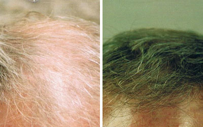 Before and after photo of male hair loss treatment