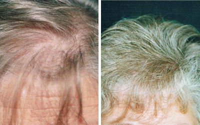 Before and after photo of female hair loss treatment