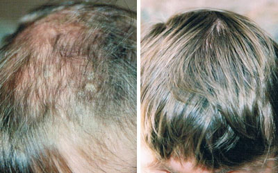 Before and after photo of female hair loss treatment