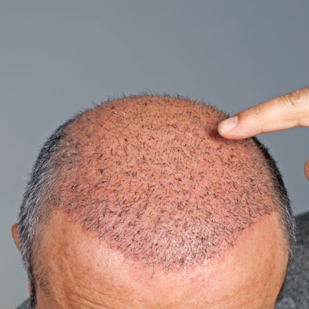 Man pointing to male pattern baldness