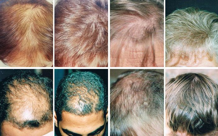 Before and after photos of hair loss treatments for men and women
