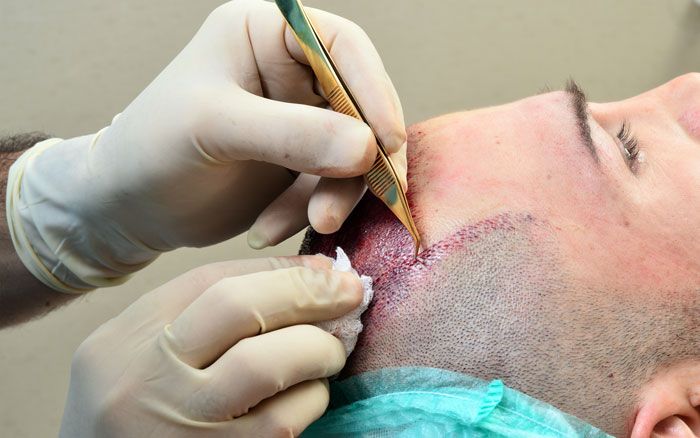 Surgical hair replacement being carried out on young man